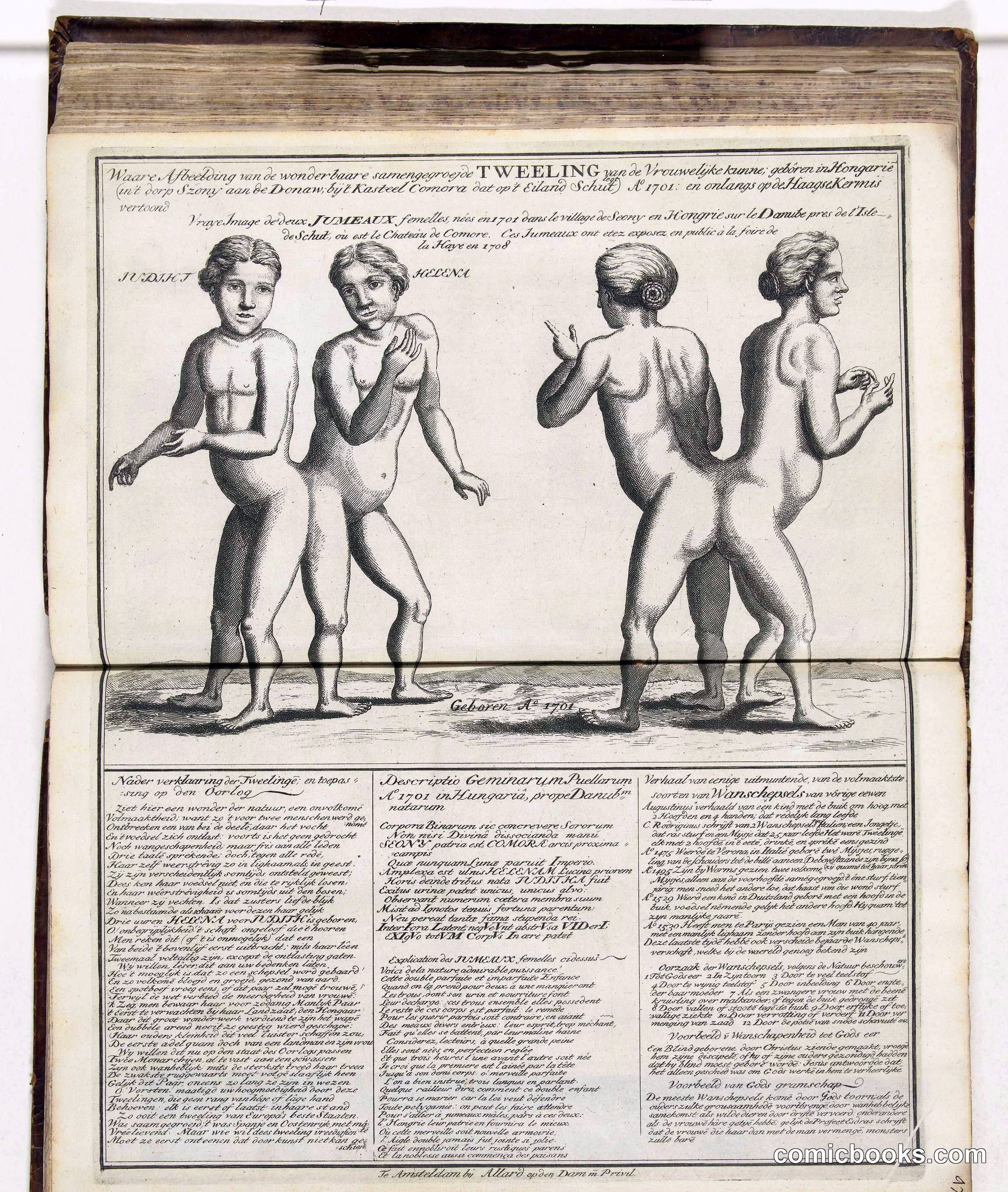 Siamese Twins from Hungary